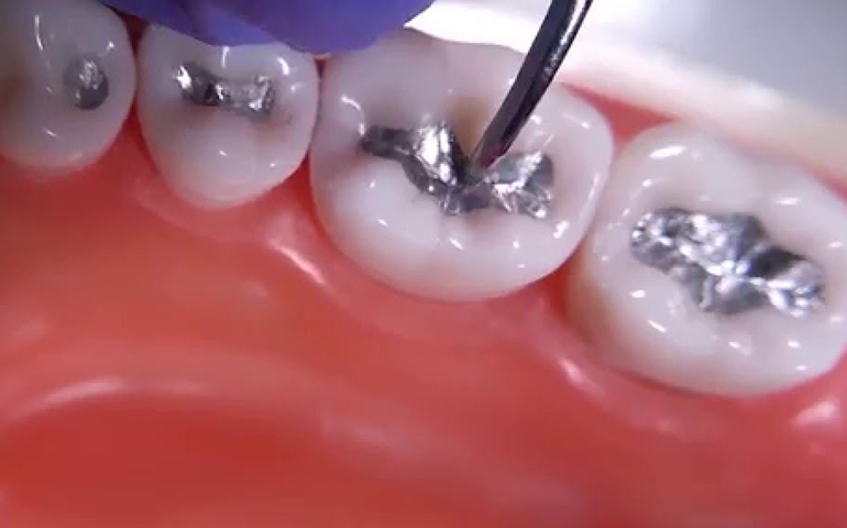 Dental amalgam fillings Facts